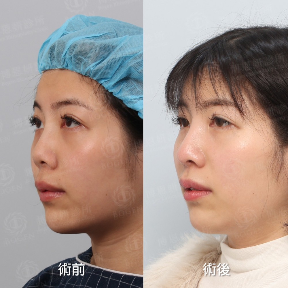 朝天鼻,朝天鼻手術,朝天鼻手術案例,博恩妍